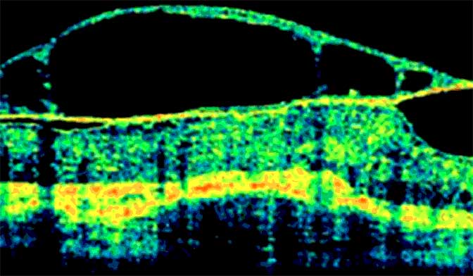 Optische Kohärenztomographie